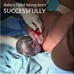 Baby's head born successfully
