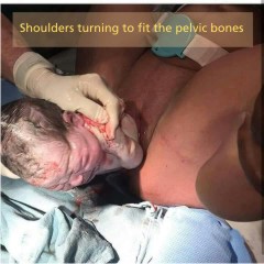 Baby's shoulder turns to fit Pelvic bones